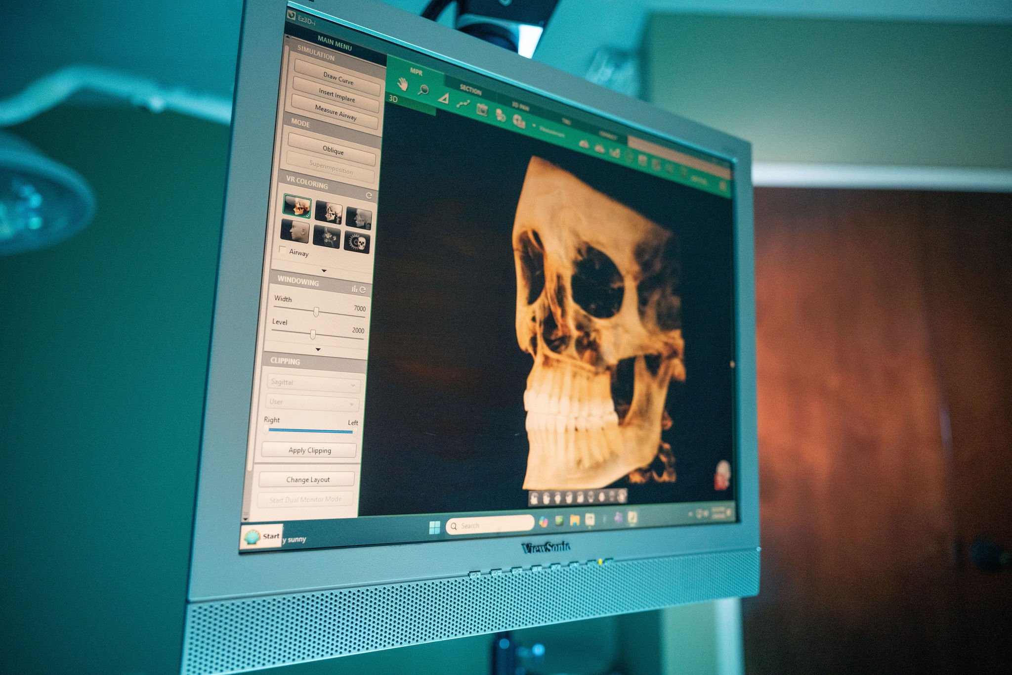 Oral Surgery | Lake Norman Oral & Facial Surgery, Huntersville, NC